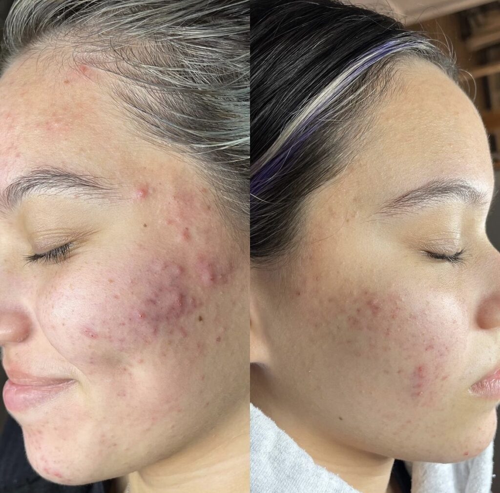 Retinol before and after picture from Instagram accont.
