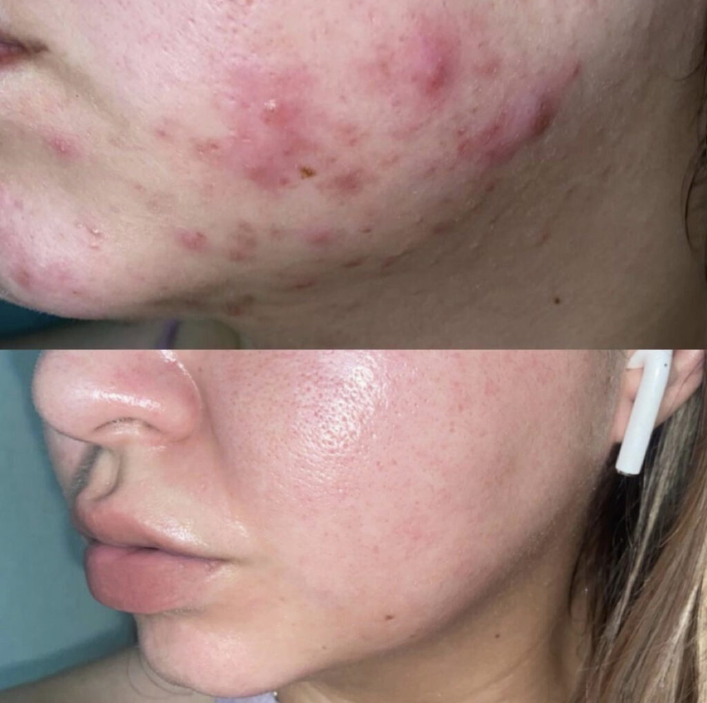 Retinol before and after shot from Instagram showing how it helped clear up a person's red flare up acne on chin.