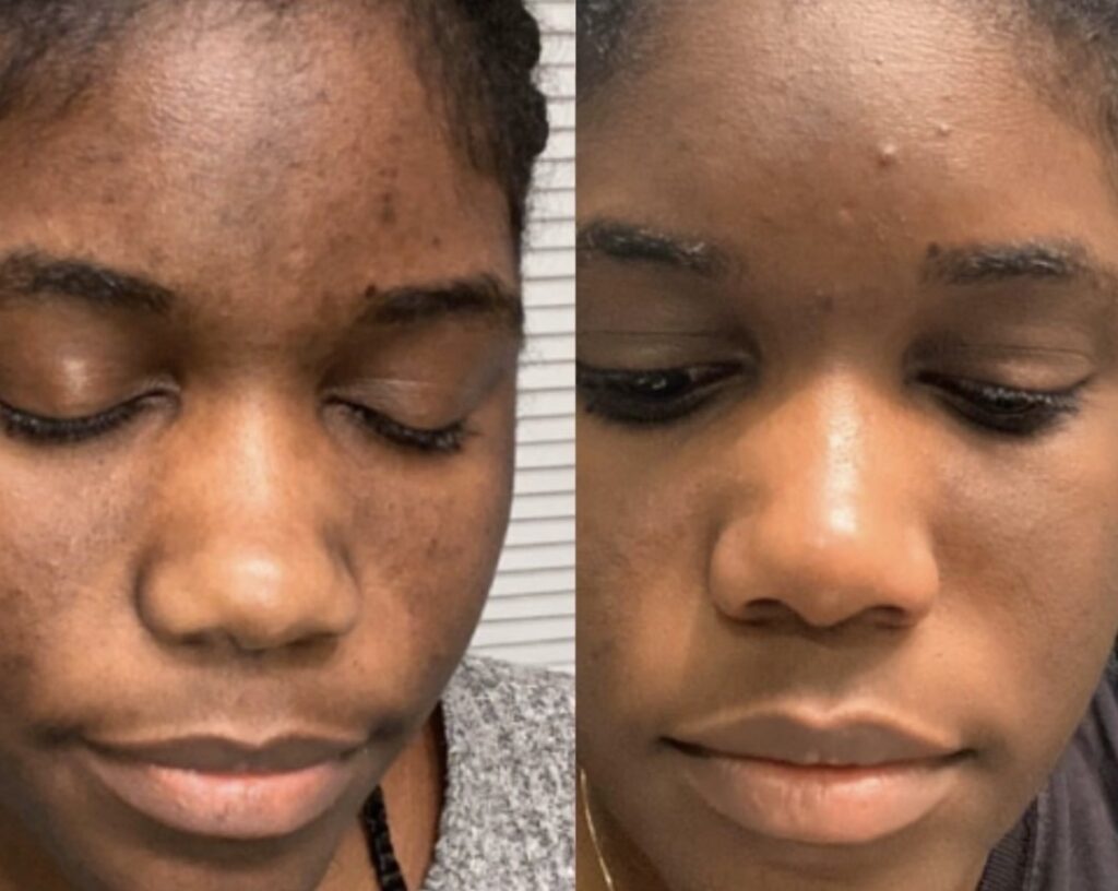 Retinol before and after picture of it helping clear up skin on an individual's forehead.