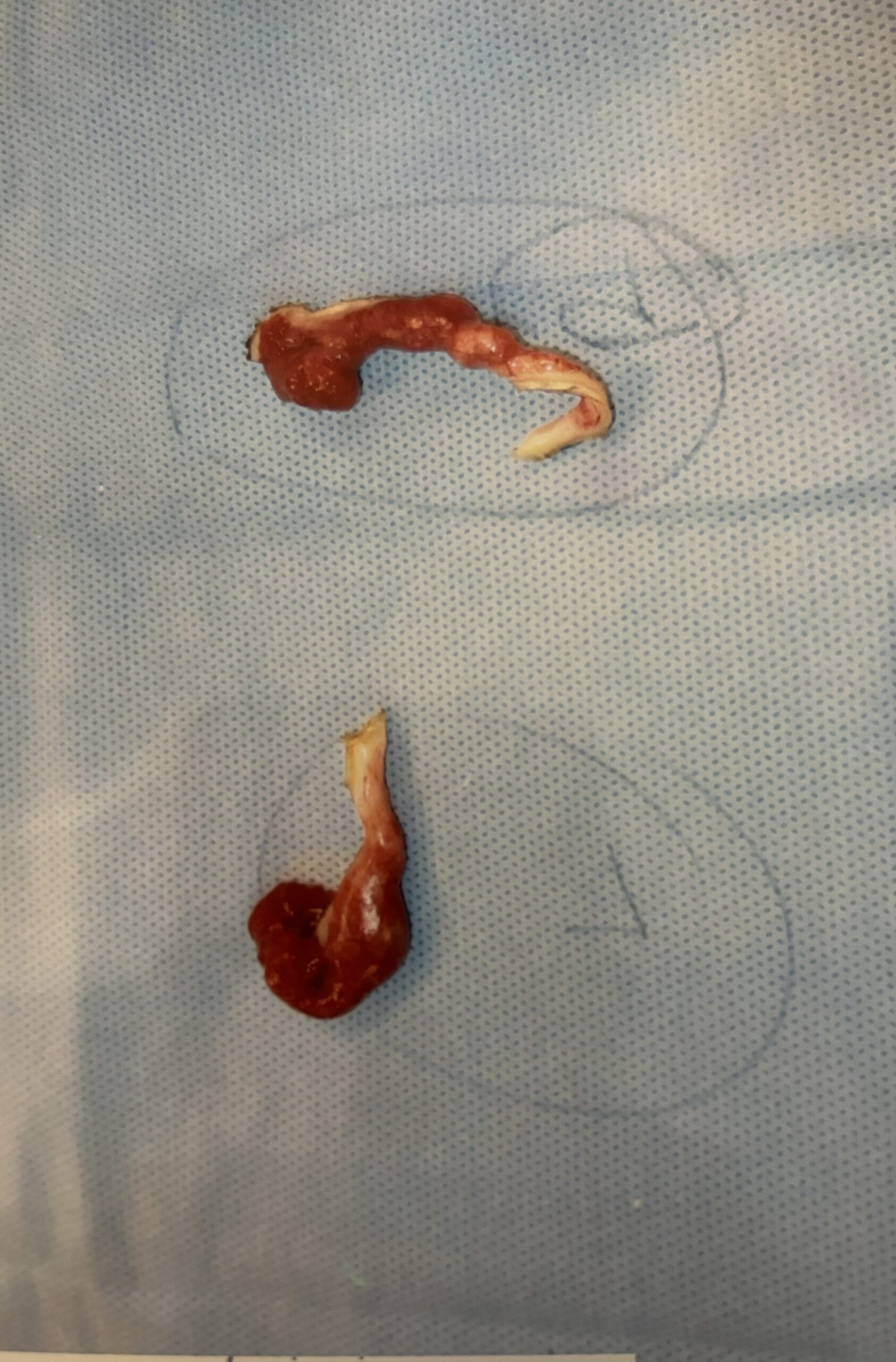 Fallopian tubes removed during hysterectomy.