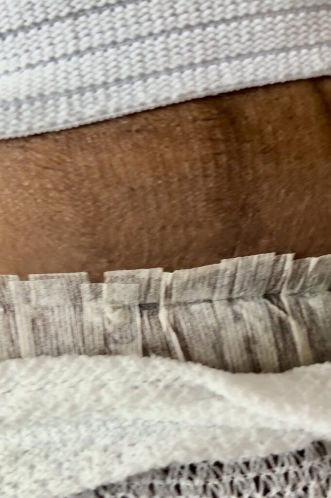 Hysterectomy scar picture from Black woman.