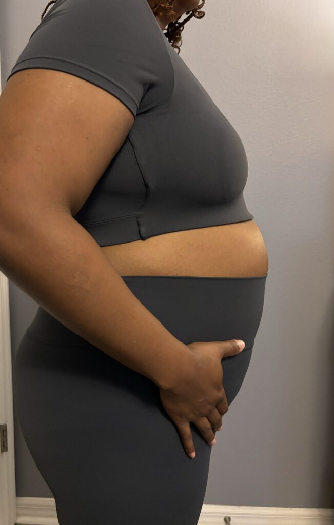 Black woman shows stomach before hysterectomy surgery.